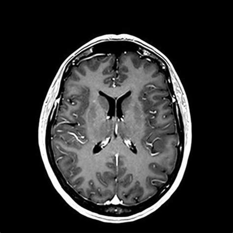 the villages brain mri with contrast|Brain MRI: What It Is, Purpose, Procedure & Results .